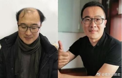 『恢复』植发术后恢复过程中可能出现什么问题?