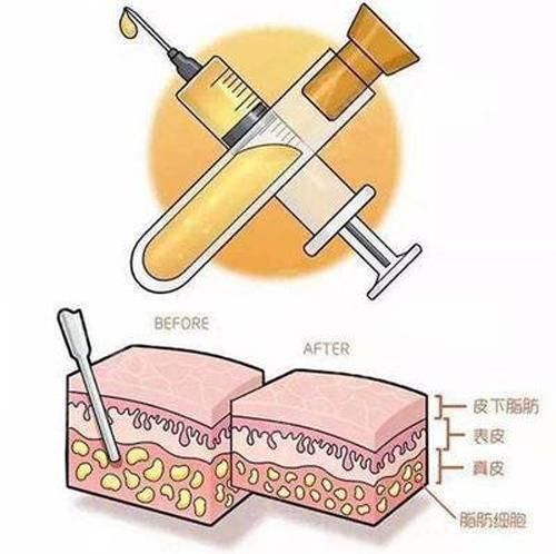  难度：吸脂手术分部位解析吸脂难度和后遗症发生可能