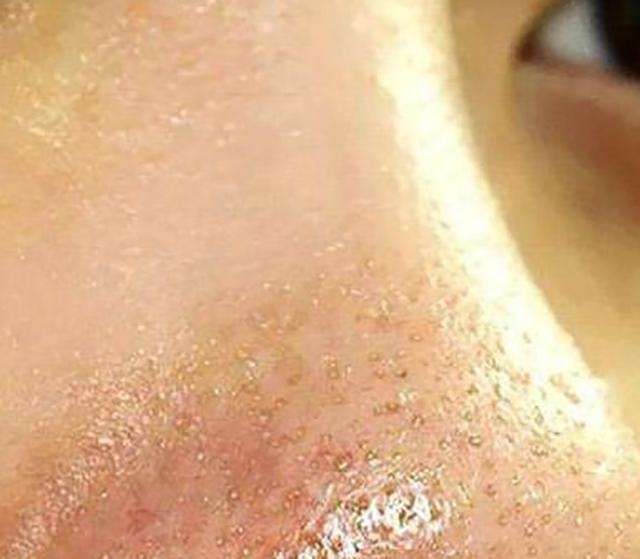 说实话:螨虫超出这个数,4个危害步步紧逼,再不除螨,脸要毁掉