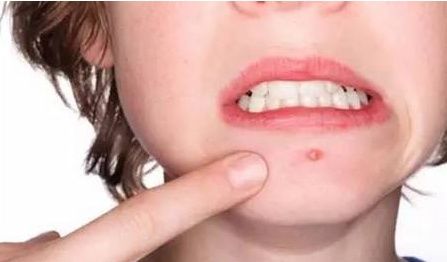 教你额头上长痘痘快速消除,经验太有用了