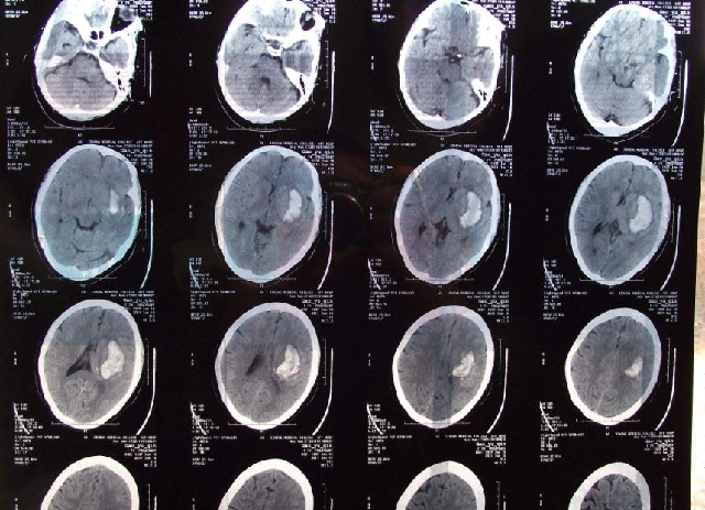 PET-CT和X光、B超、CT、MRI有什么区别?