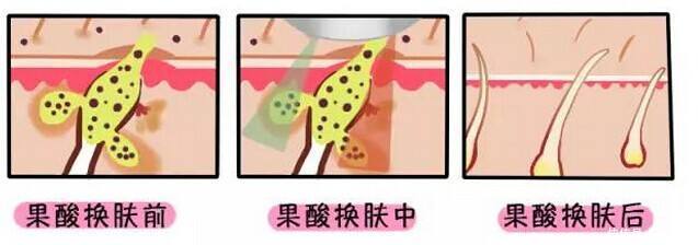 「粗大」还在为毛孔粗大而烦恼吗?集美们,看过来,这样做让你的肌肤细嫩无瑕!
