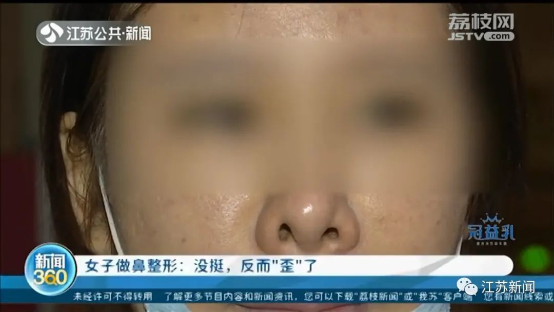  修复@瑟瑟发抖！女子整容后鼻头斜了，修复一下结果鼻孔又歪了！