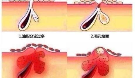  『皮肤』用了劣质洗面奶洗脸会“烂脸”?那是你没选对洗面奶,一错毁所有