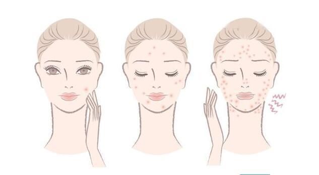 鼻子总是有“白色颗粒”冒出头?可能是螨虫在作怪哦