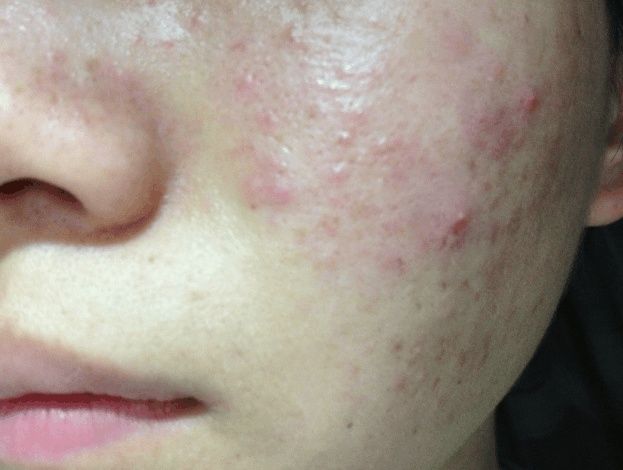 2种植物是“毛孔清道夫”, 坚持用半个月, 粗大毛孔, 痘痘不见了