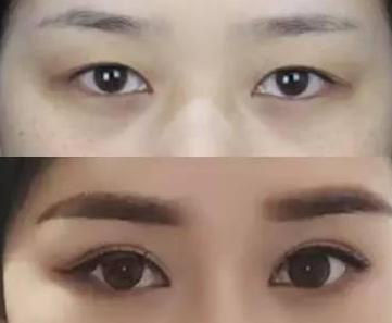 一双眼睛毁掉整张脸，这几种眼睛做双眼皮美爆了，有你没有？
