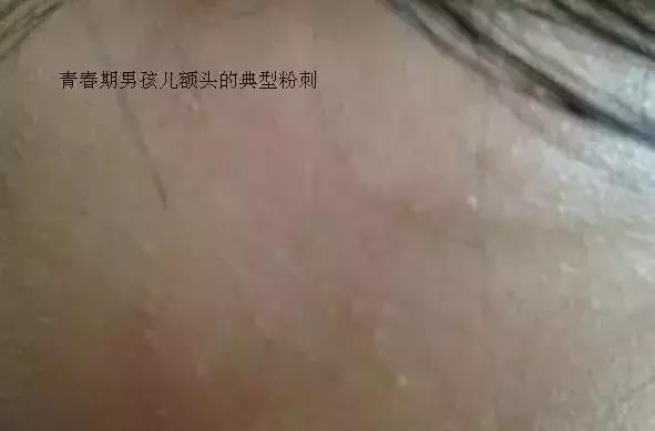 开口闭口粉刺，识别黑头白头……了解这些你冒痘的脸还有得救！