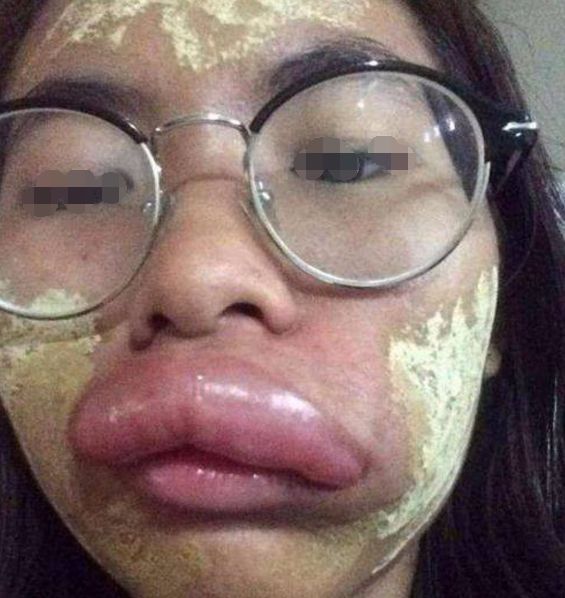 女子一觉醒来，嘴唇竟变成了“香肠”，检查后连医生都忍不住笑了