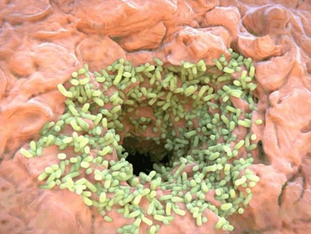 抿嘴后下巴毛孔凸起“白米粒”! 清除用2招就好