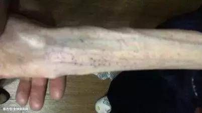 自杀式减肥--21岁女孩从110斤瘦到50斤，数着米吃饭!