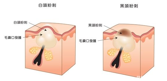  「皮肤」皮肤杀手——粉刺，怎么破？