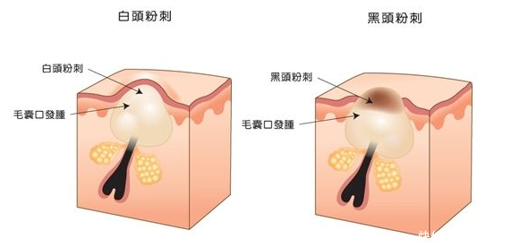「皮肤」皮肤杀手——粉刺,怎么破?