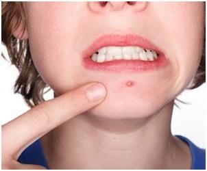 有了“痘”不知道该怎么办？