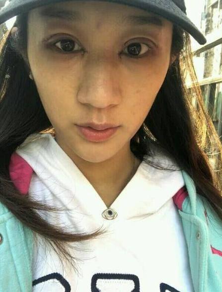 切开双眼皮真实案例分享，眼睛变大变有神了