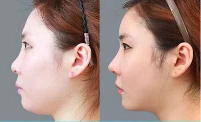 年纪轻轻就有了“双下巴”？你应该这样减！