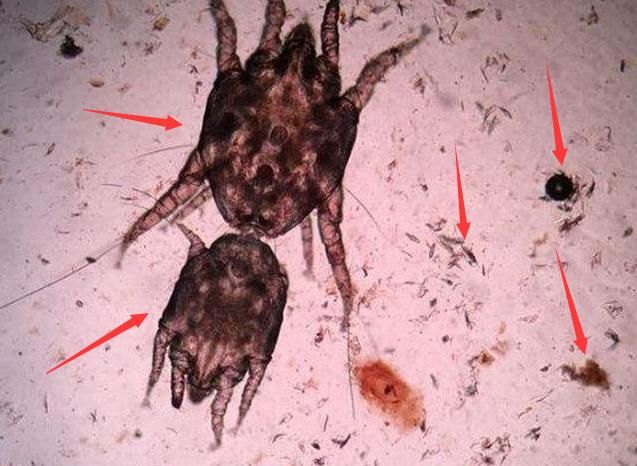 每天洗脸，鼻子上还能挤出小米粒，是螨虫一遍遍在毛孔制造垃圾！