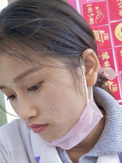  术后■鼻头肥大、山根低、没鼻梁，肋软骨隆鼻后变化有多大？