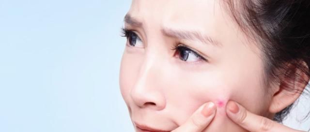 『定要注意』痘痘肌千万不要做这三件事,尤其是第二件,否则护肤品再贵都白费