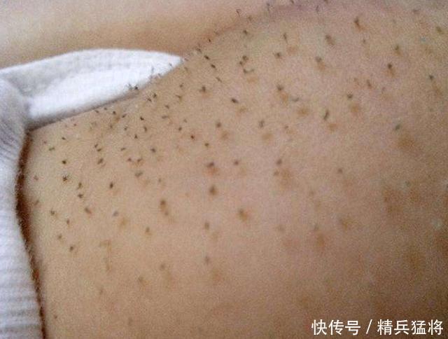 宝宝长猪毛风,妈妈拔掉黑刺孩子高烧不止,