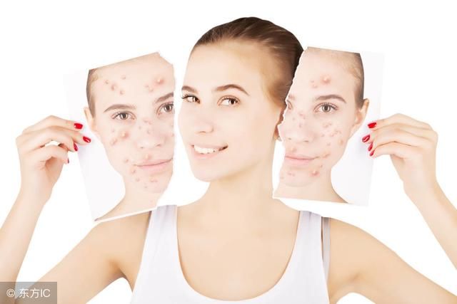 这样的痘痘肌9年了，能好吗？3个月好了，你信吗？