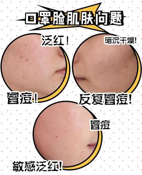  #干燥#口罩戴出干燥、敏感、痘痘？来康康烂脸女孩都是怎么自救的！