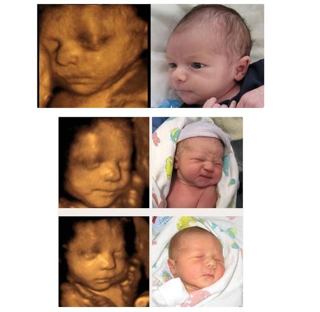 胎儿四维彩超照 VS 出生后的照片,就连亲妈都
