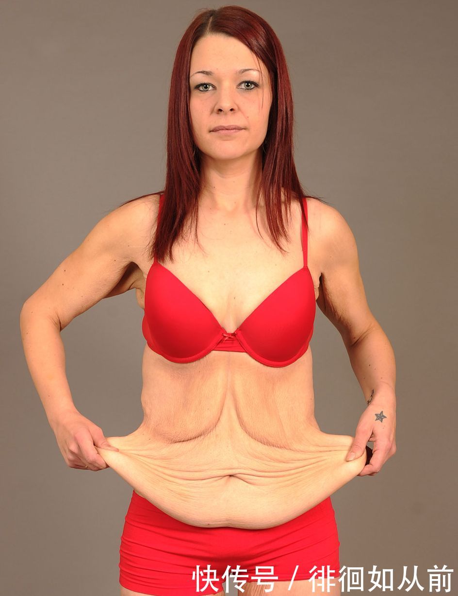 39岁女子一年减掉120斤，如今留下“尴尬”身体希望胖回去