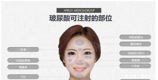 尿酸@面部除皱采用玻尿酸和肉毒素,两者的不同之处