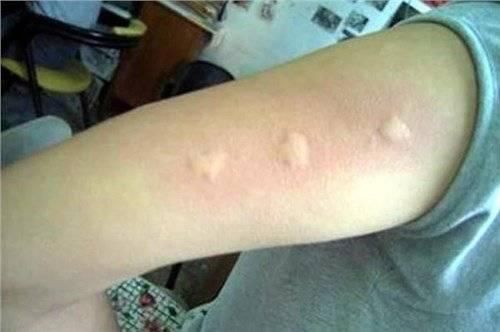  「招真」蚊子包止痒5大方法，只有这招真有用！生活小秘诀