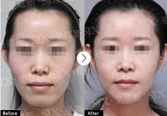 张笑天:高颧骨显老怎么办?内推就好