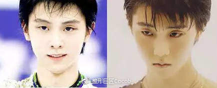 平行和扇形双眼皮该怎么选择？哪个更流行？