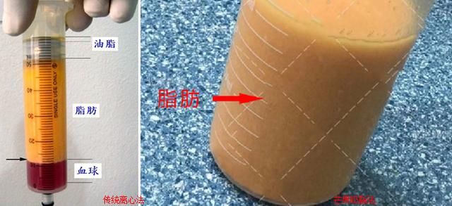  难度：吸脂手术分部位解析吸脂难度和后遗症发生可能
