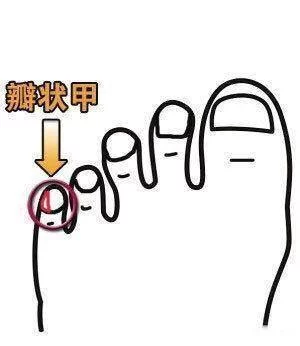 为什么有的人小脚趾甲分两半，是血统纯正的汉人？