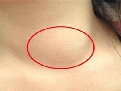 女性乳腺淋巴结肿大图图片