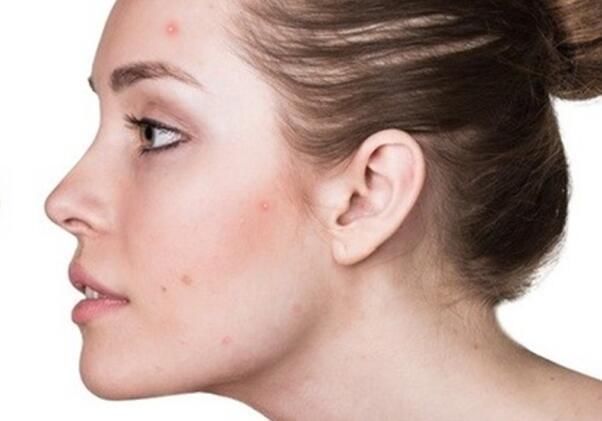 脸上有螨虫,4个问题会出现,再不除螨,脸会是你的负担