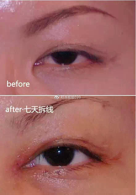  【内眦赘皮矫】需不需要看眼角……请对号入座