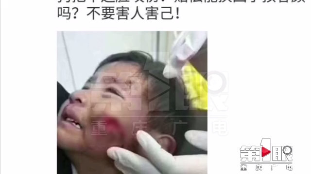 大狗咬伤小孩半边脸?朋友圈传遍了 真的假的?