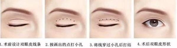 济南■「济南艺星双眼皮」别傻了！这种“无痕双眼皮”其实就是……