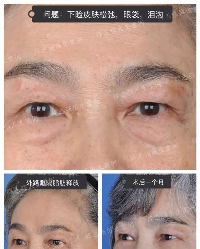  [熬夜]明明说好一起熬夜的，为什么就只有你熬出了眼袋+黑眼圈？