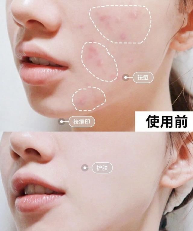  『试试』脸上出油还长痘？试试这款除螨皂，洗得干净还不紧绷
