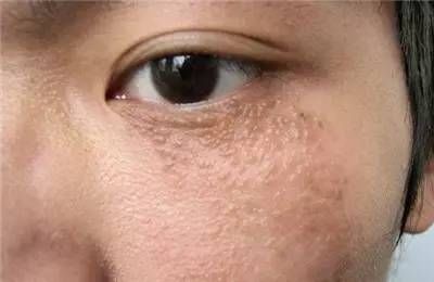 女人一定要注意:眼角长脂肪粒别挤，1个绝招轻松解决，大多不知