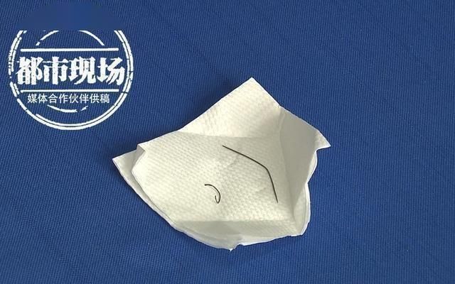  医生■7旬老人体内藏了1根6厘米的尖针还有一根断针！60年来浑然不知