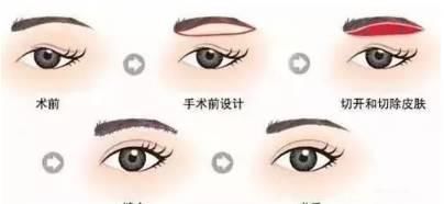  「上睑下垂」除了割双眼皮，还能如何改善自己的眼睛？
