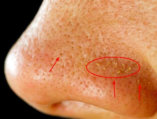 鼻子周围挤出的分泌物，原来是螨虫的分泌物，2招教你清除