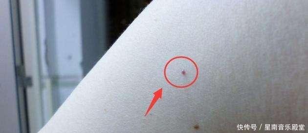 身上长了很多小红点, 像小红痣, 不痛不痒的是怎