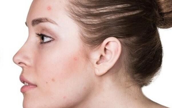  不除■脸上出油有螨虫坑坑洼洼, 不除螨, 脸注定是你的自卑