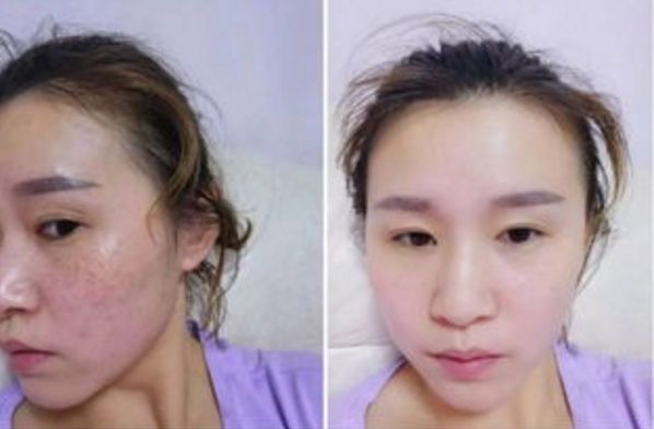 86岁退休老中医说,白醋加它,祛斑似下雨