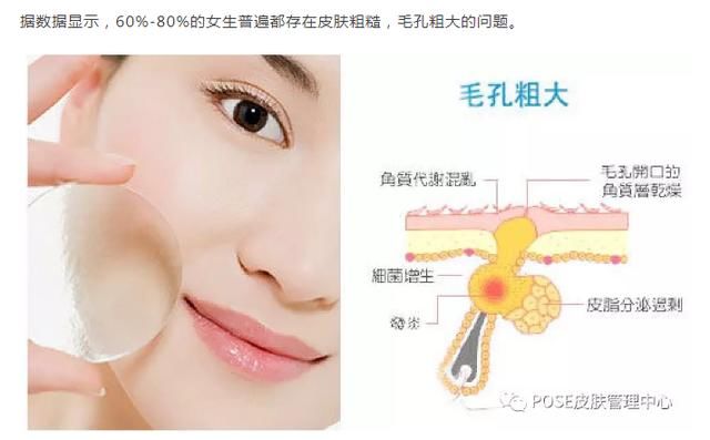 说说：毛孔粗大怎么办口服ACMETEA28天搞定！