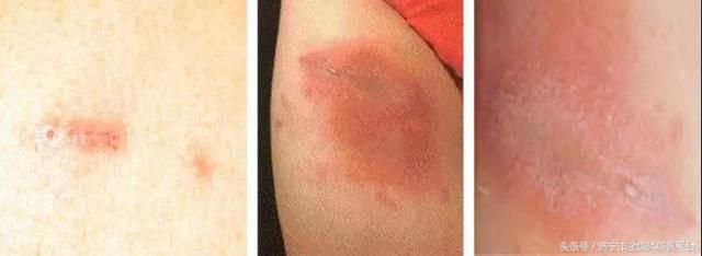 隐翅虫咬人会致命?耸人听闻的传言别再传了!